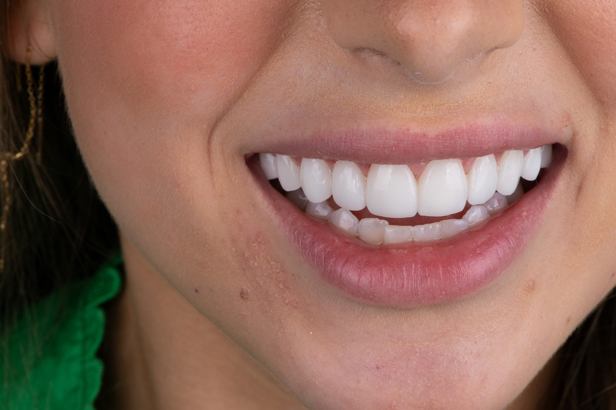Close-up of a patient's bright, even smile after Printed PERL Veneers