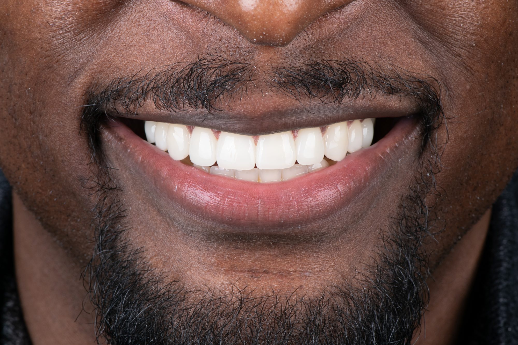 Close-up of a patient's finished smile after conservative cosmetic treatment