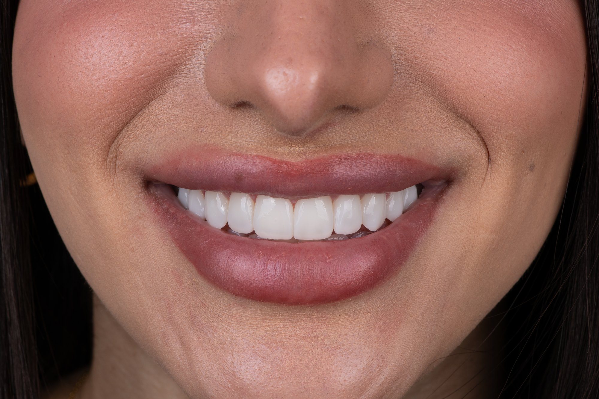 A close-up of a patient's bright, even smile after Printed PERL Veneers