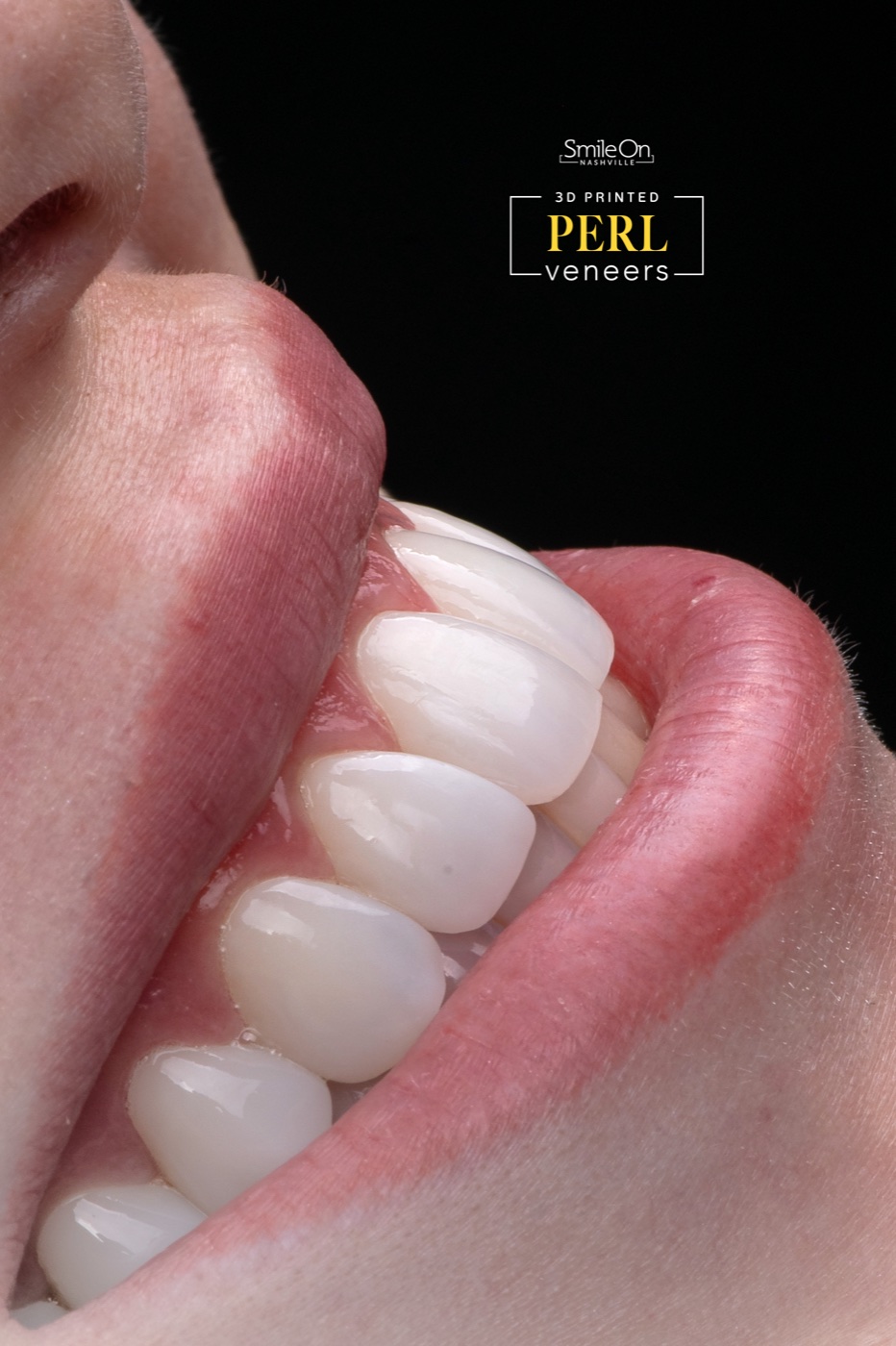 Close-up of finished veneers from the side