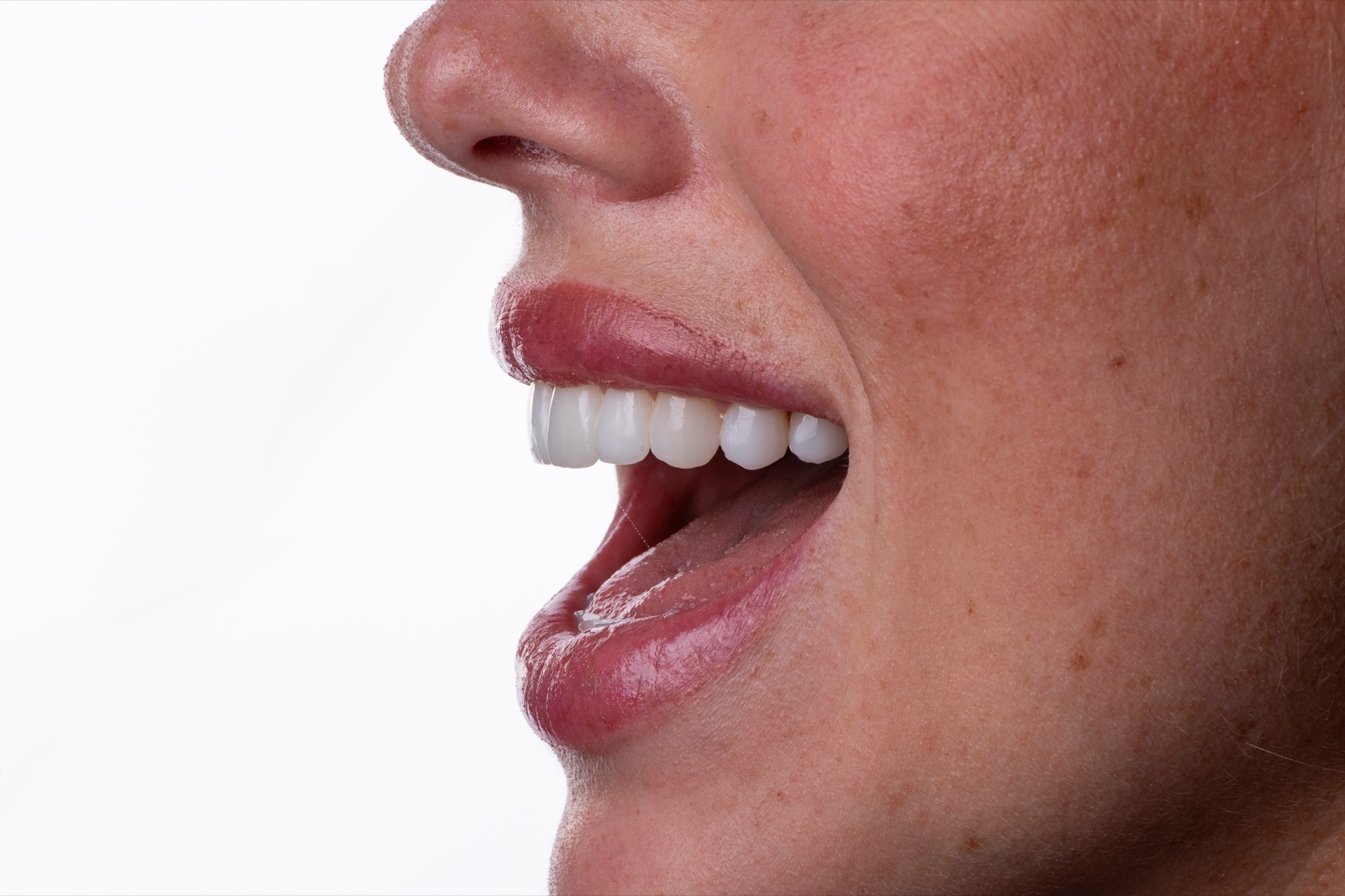 Profile close-up of a patient's finished smile