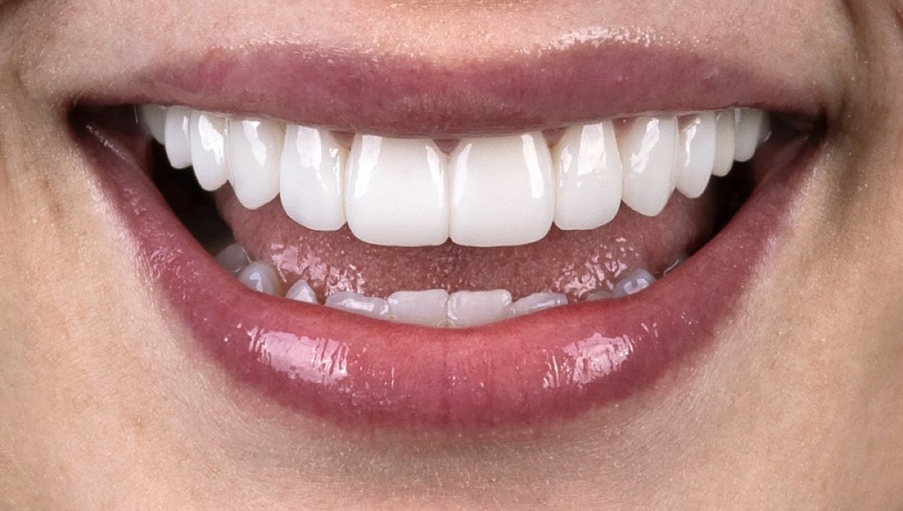 Close-up of an even, bright smile after cosmetic veneer treatment