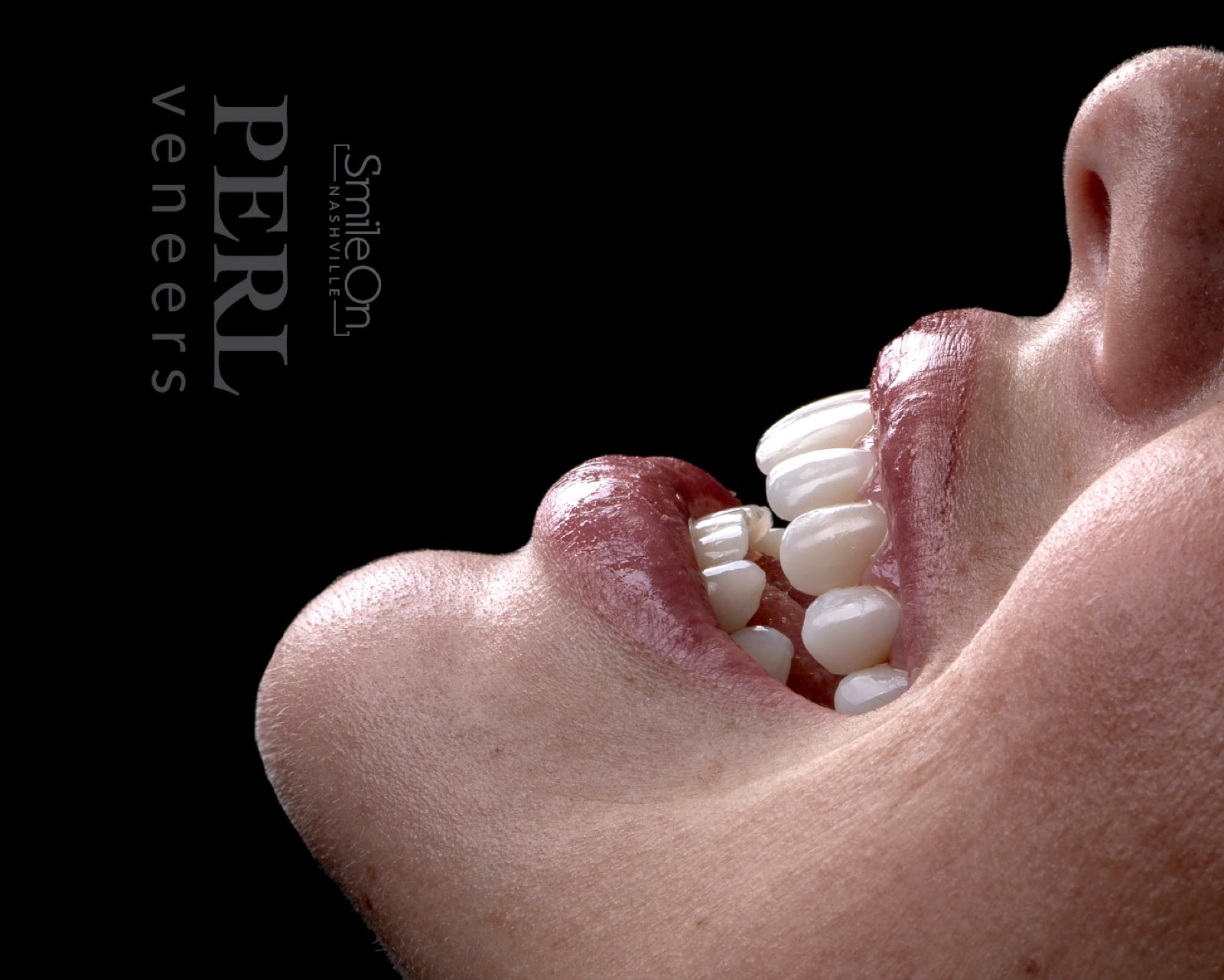 Close-up side profile of a finished PERL veneer smile