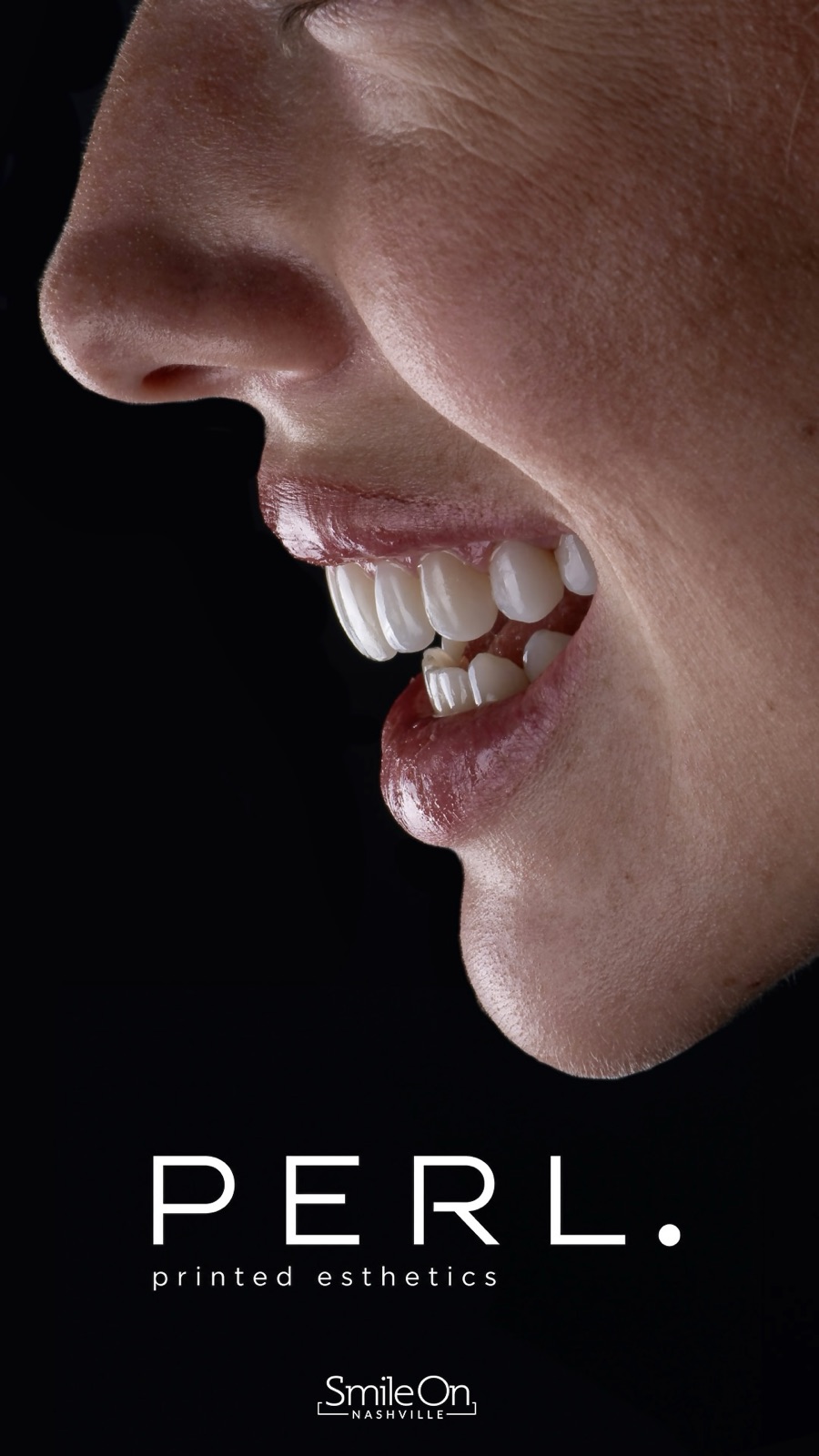 Side profile of a finished PERL veneer smile with the PERL Printed Esthetics mark