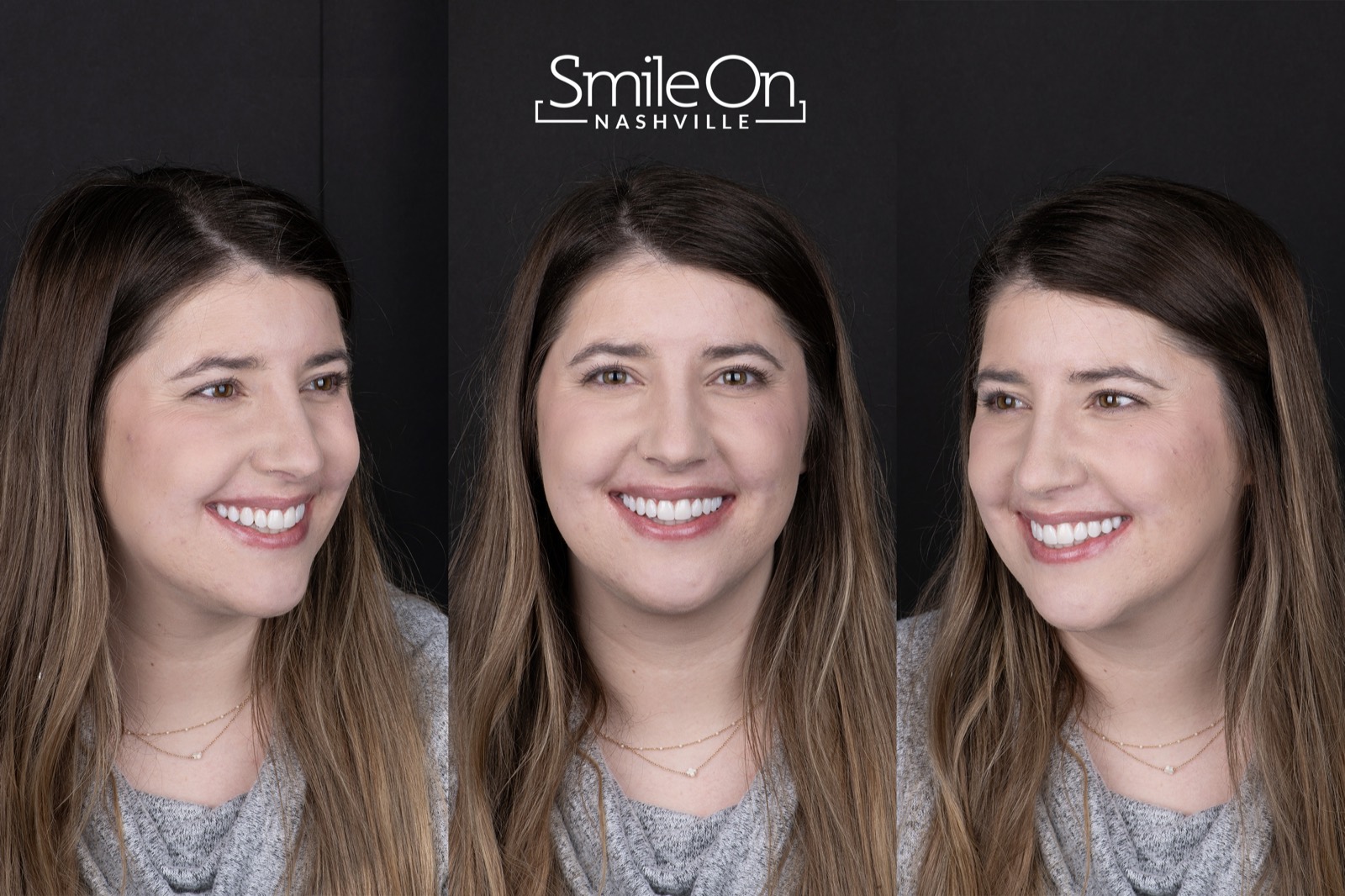Patient smile result showing a full arch PERL veneer transformation