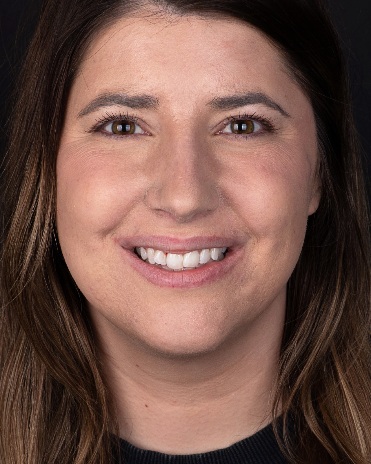 Before treatment: worn, uneven teeth ahead of a PERL veneer makeover